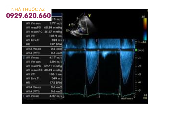 Phổ Doppler liên tục của hẹp nặng van động mạch chủ