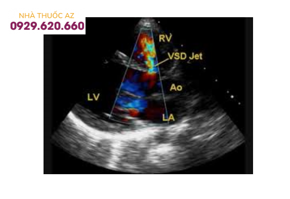 Thông liên thất được phát hiện bằng Doppler mầu (VSD jet): dòng chảy từ thất trái (LV) qua vách liên thất sang thất phải (RV), đi về phía đầu dò được để ở phía thất phải nên có mầu khảm đỏ