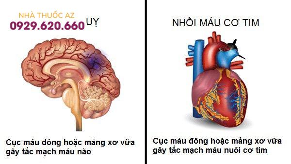 Phân biệt đột quỵ với nhồi máu cơ tim