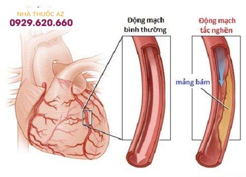 Hẹp động mạch vành
