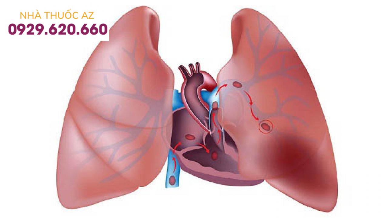 Thuyên tắc mạch phổi