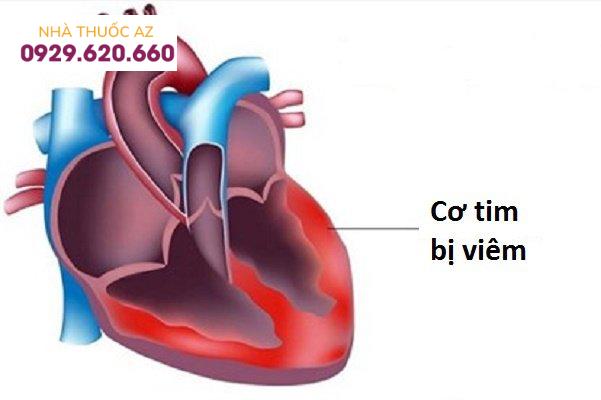 Viêm cơ tim