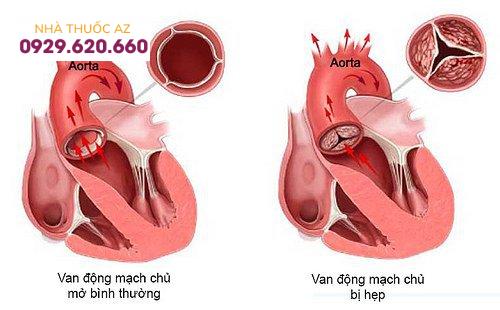 Hẹp van động mạch chủ