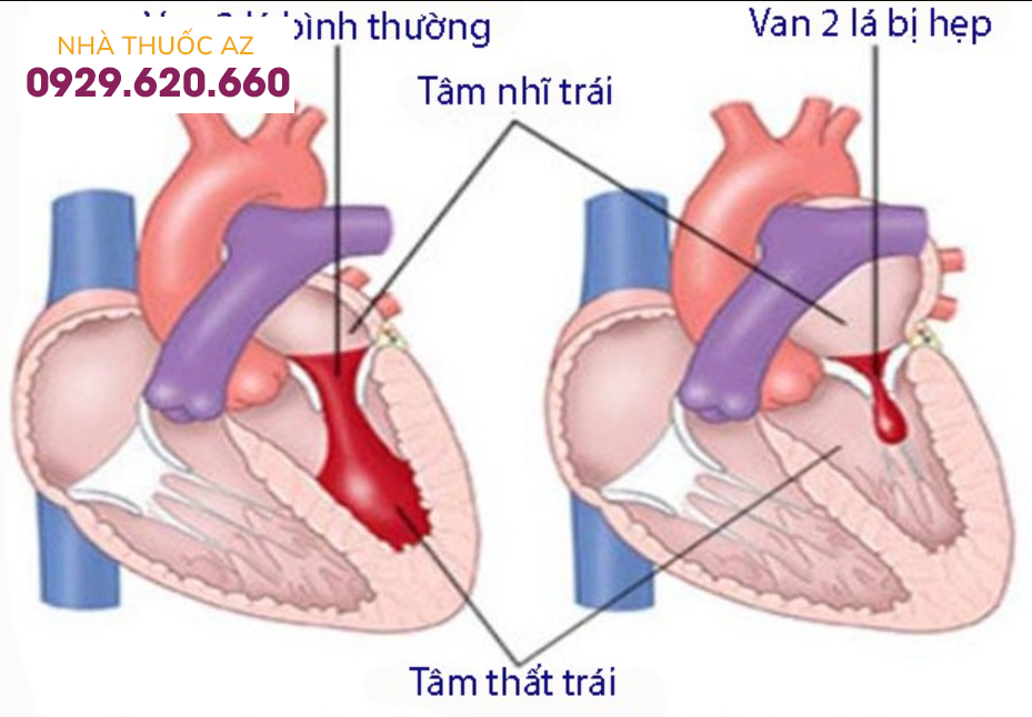 Hẹp van 2 lá