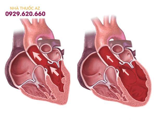 Bệnh thấp tim là bệnh gì? Đặc điểm của bệnh