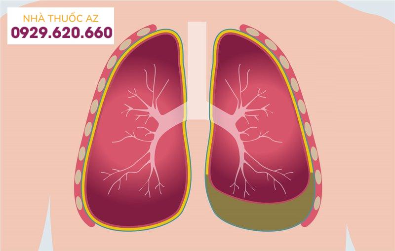 Bệnh thấp tim là bệnh gì? Đặc điểm của bệnh