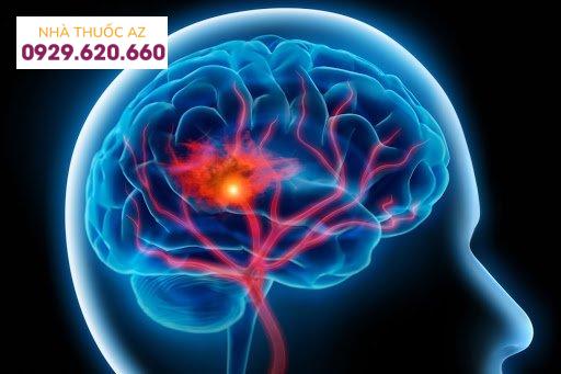 đột quỵ xuất huyết não