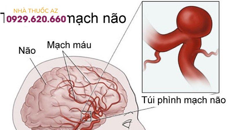 túi phình mạch máu não