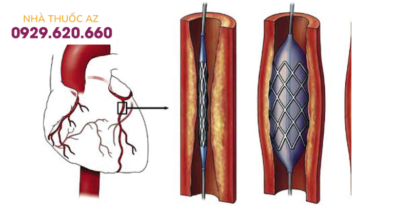 Can thiệp động mạch vành