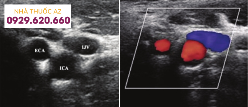 siêu âm Doppler động mạch cảnh