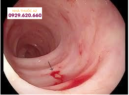 xuất huyết tiêu hóa.