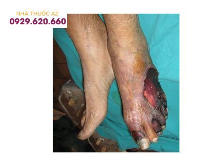 Biến chứng của hẹp động mạch