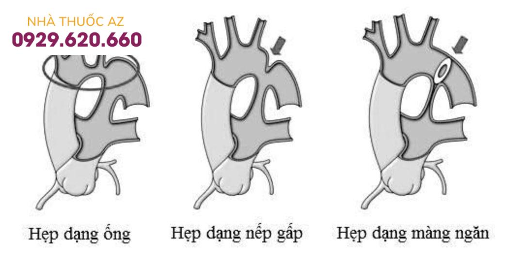 Các dạng hẹp eo động mạch chủ