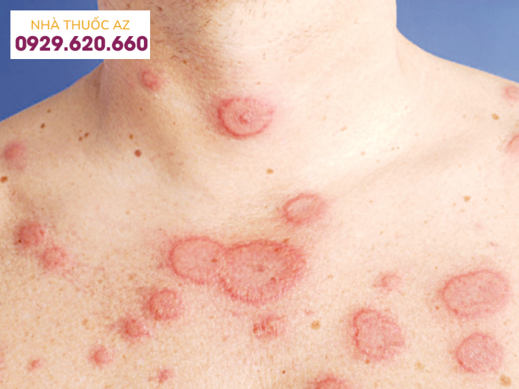 MSC có thể điều trị bệnh lupus ban đỏ