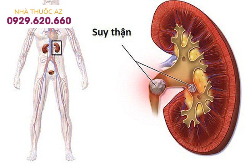 Cần thận trọng khi dùng thuốc đối quang đối với bệnh nhân mắc suy thận nặng