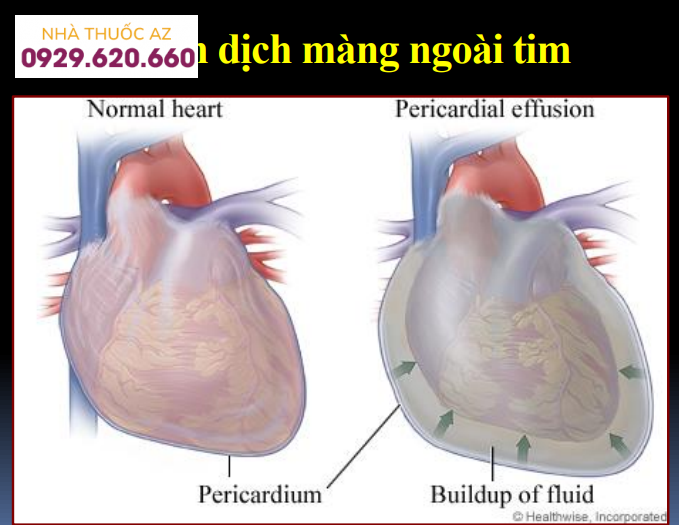 Tràn dịch màng ngoài tim