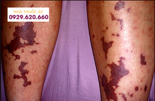 Đông máu nội mạch lan tỏa