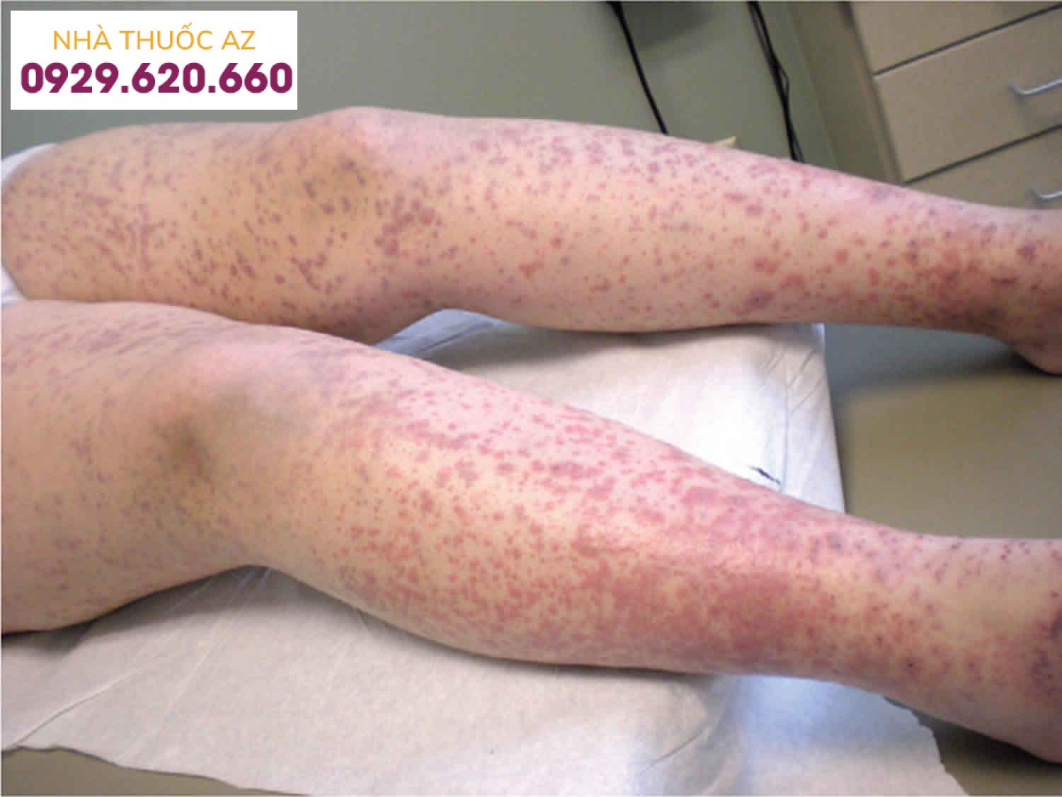 Đông máu nội mạch lan tỏa