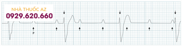 Điện tim block nhĩ thất cấp 3