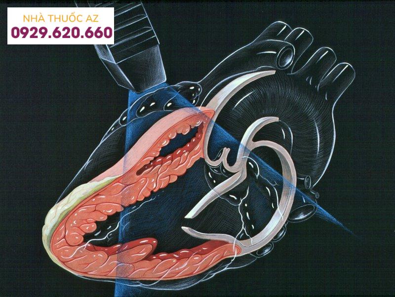 Siêu âm tim cơ bản phát hiện được bệnh gì?