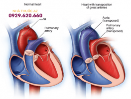 Chuyển vị đại động mạch