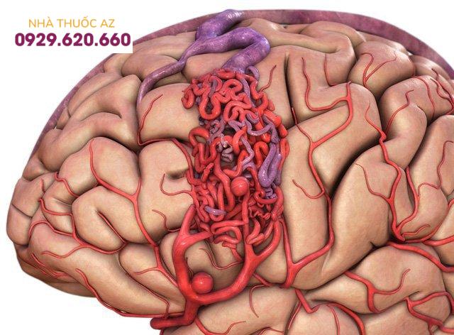 dị dạng mạch máu não (AVM)
