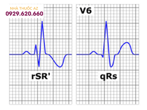 Block nhánh phải ở tim