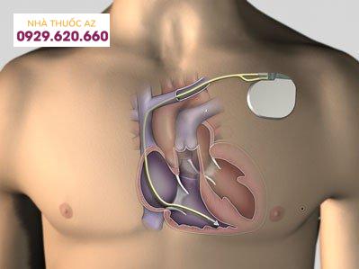 Block nhánh phải nặng cần được đặt máy tạo nhịp vĩnh viễn