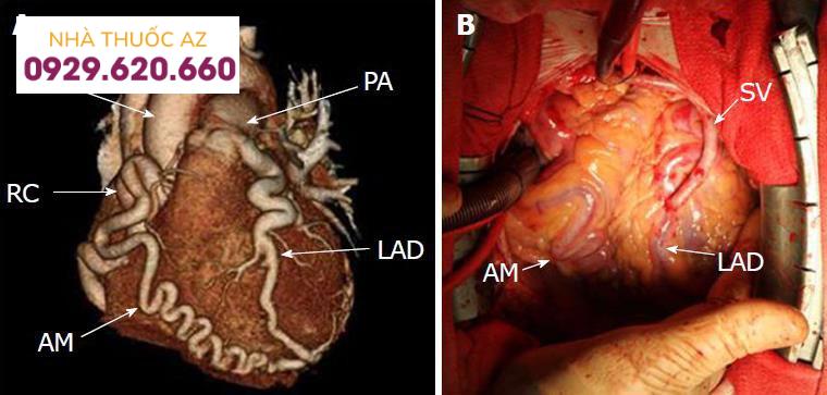 bất thường của động mạch vành trái từ động mạch phổi ở người trưởng thành