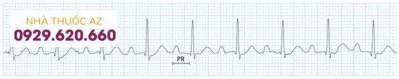 Block nhĩ thất (AV) cấp 1 (khoảng PR > 200 ms).