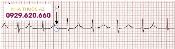Block nhĩ thất (AV) vớ sóng P được ẩn trong các sóng T trước.