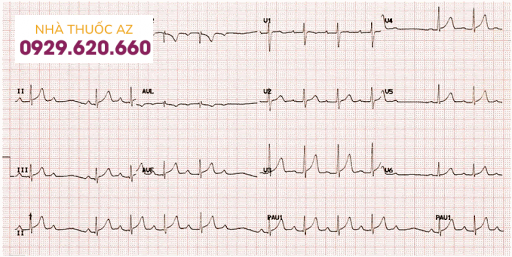 Hình 3: Chu kỳ Wenckebach điển hình