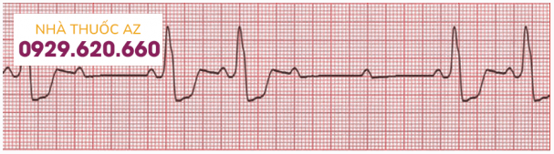 Hình 4: Block nhĩ thất cấp II loại 2