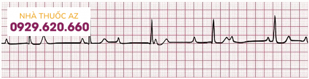 Hình 5: Block nhĩ thất hoàn toàn