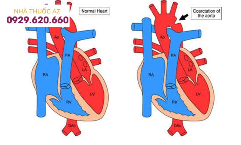 Hẹp động mạch chủ
