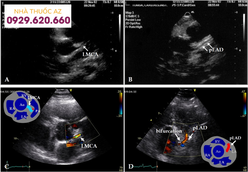 van động mạch chủ