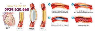 Chỉ định của nong và đặt stent động mạch vành