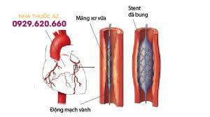 So với sử dụng stent thông thường, đặt stent phủ thuốc có tỷ lệ tái hẹp mạch vành thấp hơn đáng kể