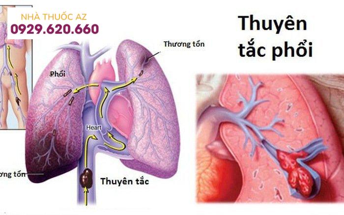 thuyên tắc động mạch phổi