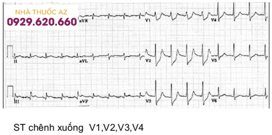 Nhồi máu cơ tim cấp không tăng sóng ST