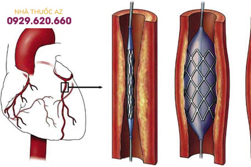 Chỉ định của nong và đặt stent động mạch vành