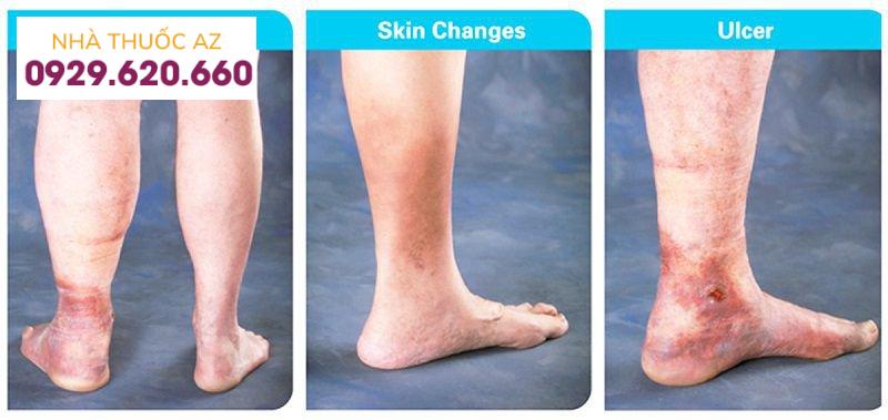 Huyết khối tĩnh mạch sâu chi dưới