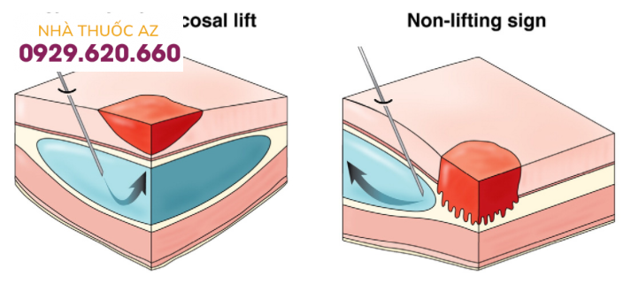 Dấu hiệu nonlifting trong ung thư dạ dày giai đoạn dầud