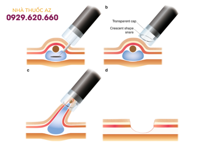 Điều trị ung thư dạ dày