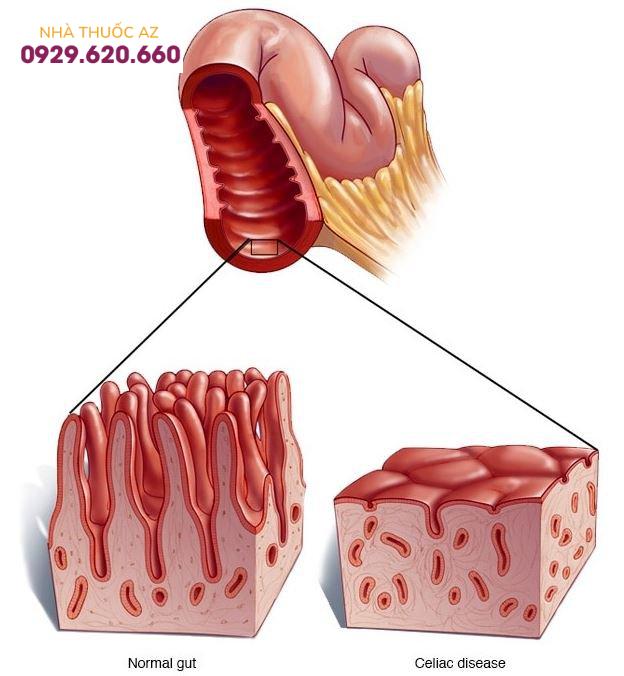 bệnh celiac rối loạn tiêu hóa