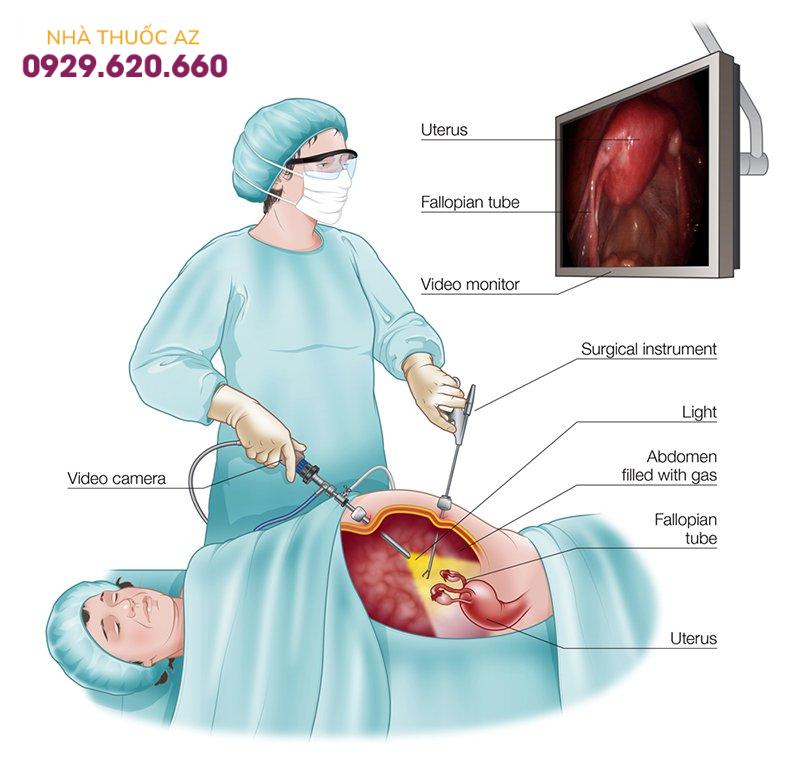Nội soi ổ bụng