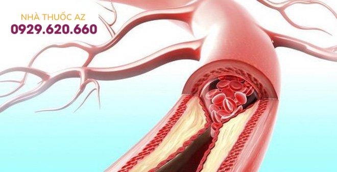 Tìm hiểu về bệnh lý tăng áp phổi