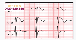 Đặc điểm hội chứng Brugada