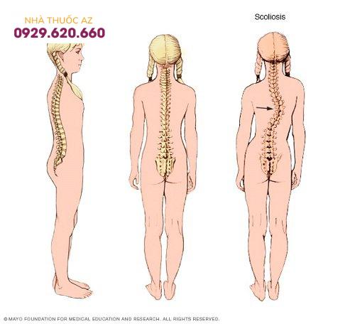 tổn thương tim do hội chứng Marfan