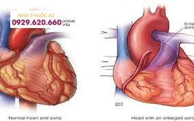 tổn thương tim do hội chứng Marfan